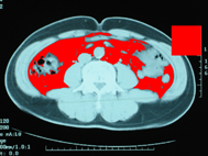 abdominal CT