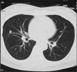 CHEST-CT